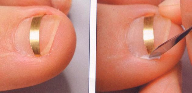Лечение вросшего ногтя с помощью золотой пластины